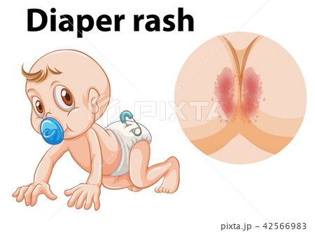 A baby with diaper rash 42566983