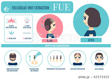 Fue Treatment Infographic For Womenのイラスト素材
