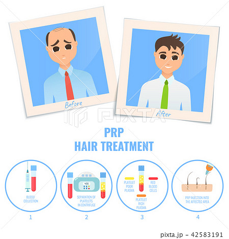 Man before and after PRP treatment 42583191