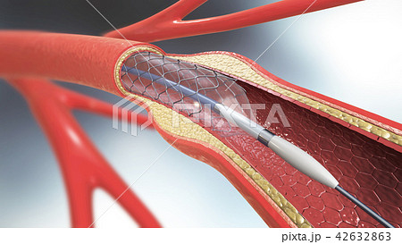 stent implant for supporting blood circulation 42632863