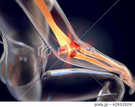injured elbow called tennis elbow 42632924