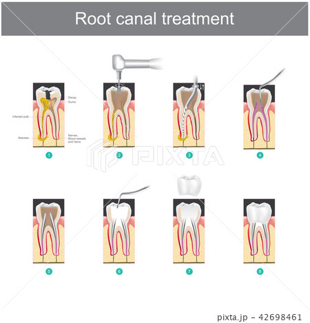 Root canal treatment. 42698461
