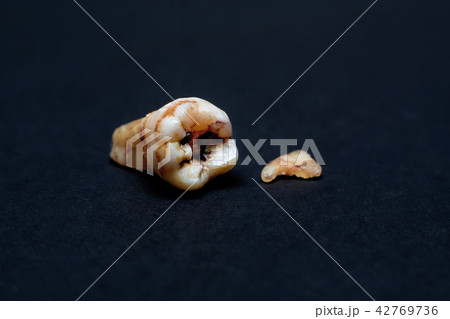 Broken Caries Molar on the iSolated. 42769736