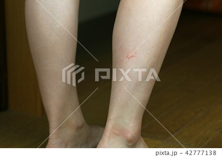 足の虫刺され 42777138