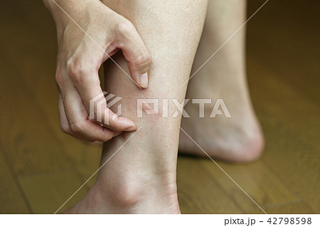 虫刺され 42798598