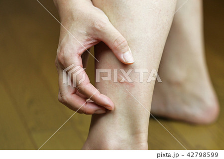 虫刺され 42798599