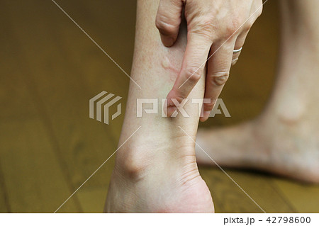 虫刺され 42798600