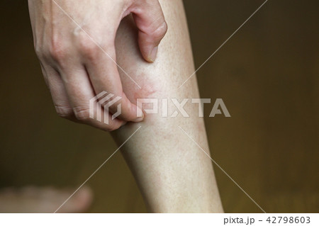 虫刺され 42798603