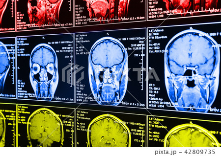 Magnetic resonance scan of the brain Magnetic resonance scan of the brain 42809735