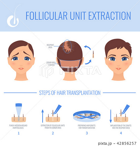 Transplantation With Fue In Womenのイラスト素材