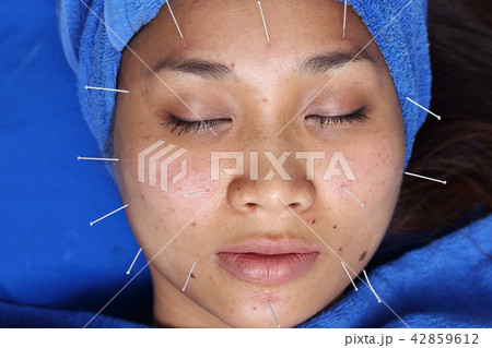 Hand Perform Medical professional acupuncture Hand Perform Medical professional acupuncture 42859612