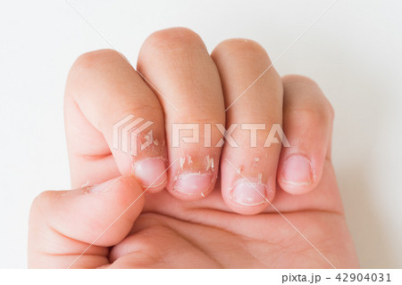 Close up child's fingers with dry skin Close up child's fingers with dry skin 42904031