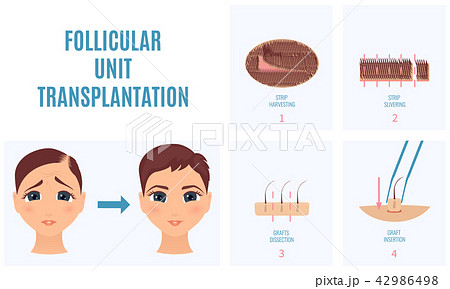 FUT treatment for women FUT treatment for women 42986498