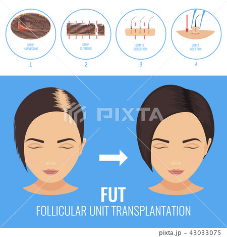 FUT treatment for women 43033075