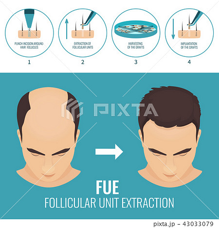 Fue Hair Loss Treatmentのイラスト素材