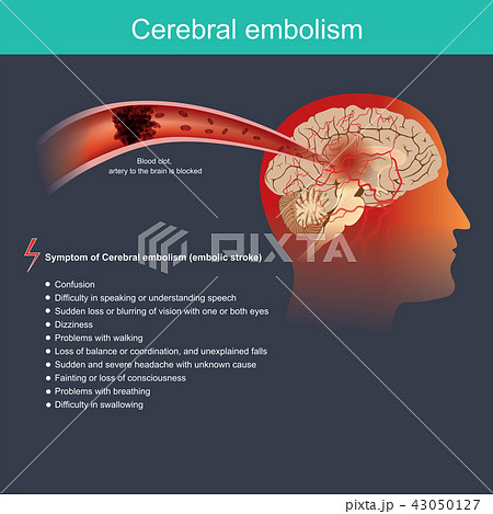 Cerebral embolism. Anatomy body, Health care. 43050127