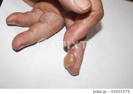 Burns on finger Burns on finger 43055379