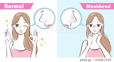 woman with blackhead problem 43061330