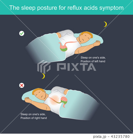 The sleep posture for reflux acids symptom 43235780
