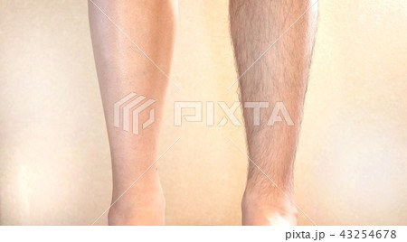 男性の足ビフォーアフター 43254678
