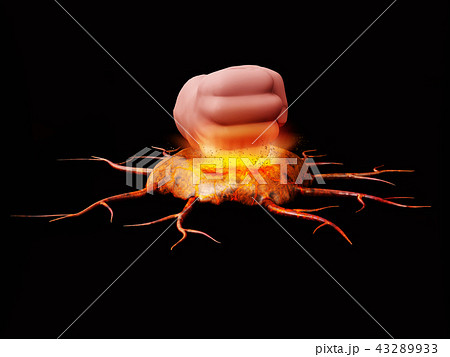 Concept as a heavy fist crushing and smashing cancer cells 3d Illustration 43289933
