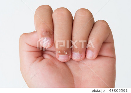 Close up child's fingers with dry skin Close up child's fingers with dry skin 43306591