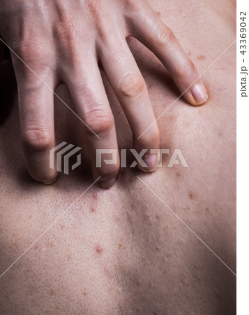Woman with skin problem acne on back 43369042