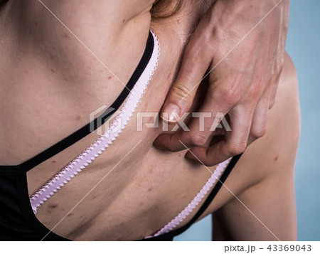 Woman with skin problem acne on back 43369043