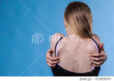 Woman with skin problem acne on back Woman with skin problem acne on back 43369044