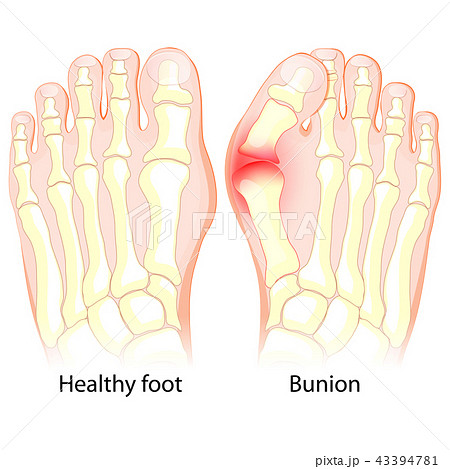 Bunion. Human anatomy. Skeleton Bunion. Human anatomy. Skeleton 43394781