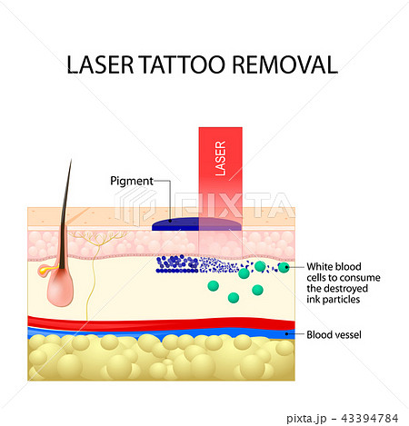 Laser tattoo removal. Laser tattoo removal. 43394784