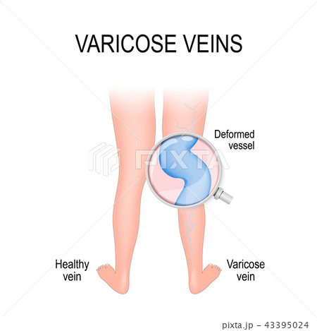 varicose vein and normal vein varicose vein and normal vein 43395024