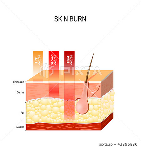 skin burn. Three degrees of burns. skin burn. Three degrees of burns. 43396830