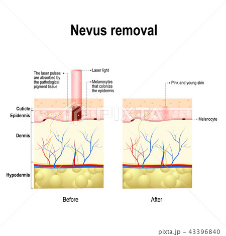 Moles spots or nevus removal 43396840