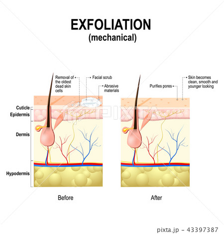 Exfoliation or peel is cosmetic procedures 43397387