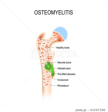 Osteomyelitis is infection in the bone 43397390