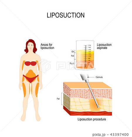 Liposuction process and areas for lipo 43397400