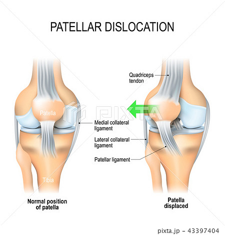 Patellar dislocation 43397404