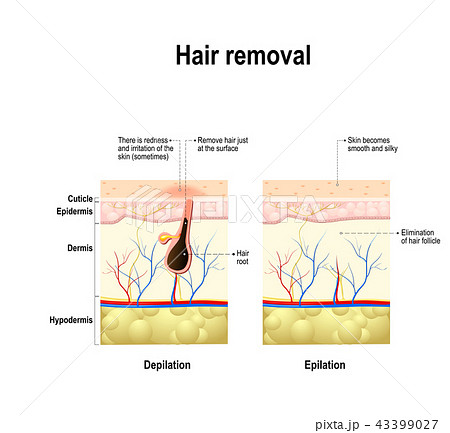 epilation and depilation difference 43399027