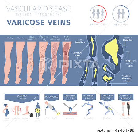 Vascular diseases. Varicose veins infographic Vascular diseases. Varicose veins infographic 43464799