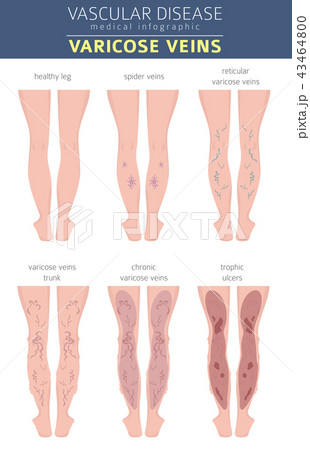 Vascular diseases. Varicose veins infographic 43464800