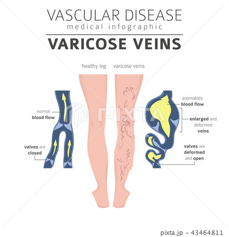 Vascular diseases. Varicose veins infographic 43464811