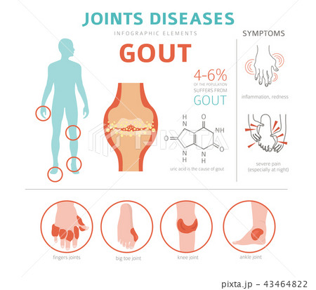 Joints diseases. Gout infographic Joints diseases. Gout infographic 43464822