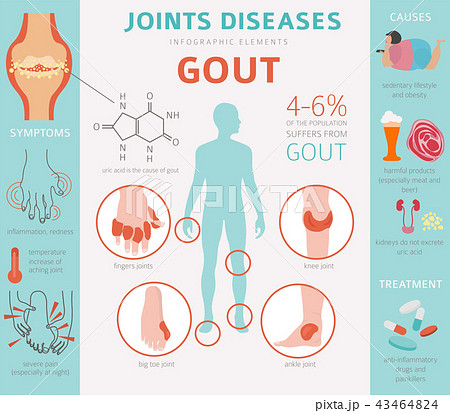 Joints diseases. Gout infographic 43464824