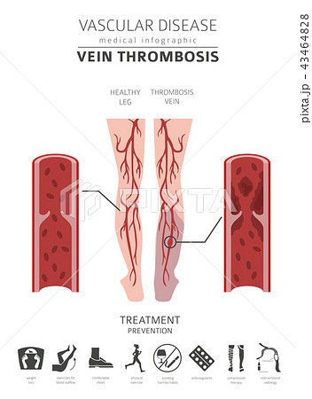 Vascular diseases. Vein thrombosis infographic 43464828