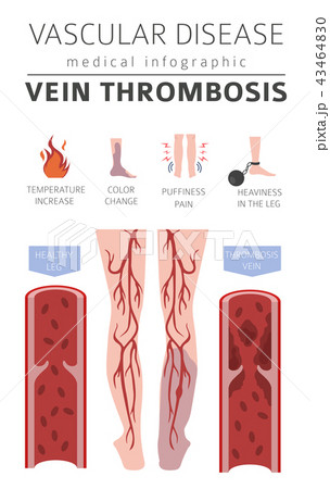 Vascular diseases. Vein thrombosis infographic Vascular diseases. Vein thrombosis infographic 43464830