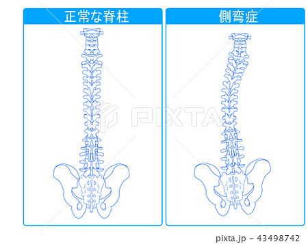 正常な脊柱と側弯症の比較1 43498742