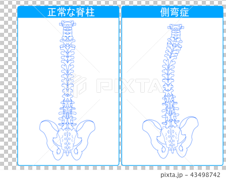 正常な脊柱と側弯症の比較1 43498742