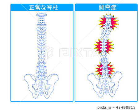 正常な脊柱と側弯症の比較2 43498915