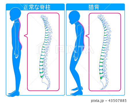 正常な脊柱と猫背の比較のイラスト素材